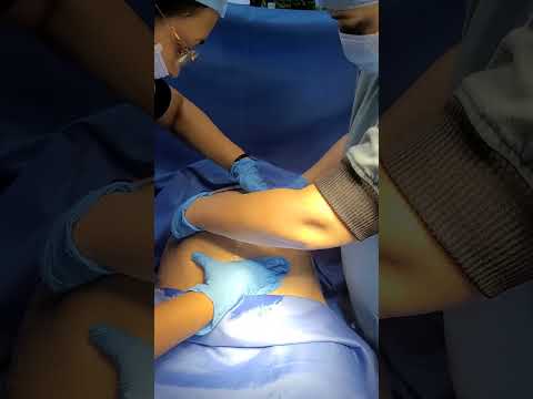 External cephalic version