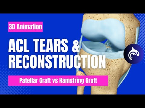 ACL Tear & ACL Reconstruction (Patellar Harvest vs Hamstring Harvest) - 3D Animation