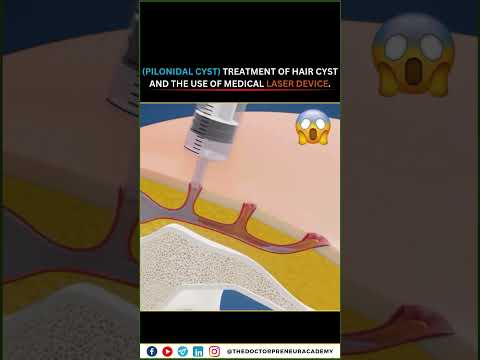 Treatment for Pilonidal Cysts: How Medical Lasers are Changing the Game!