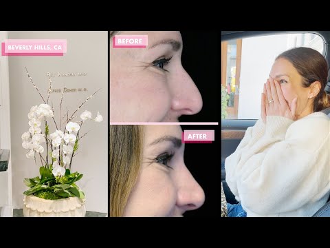 My Sister's Dr. Raj Kanodia Nose Makeover