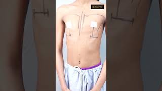 Breast Implant Surgery result