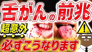 【堀ちえみさんも】口内炎が前兆?知らないと後悔する「舌がん」の初期症状。意外な兆候と見分け方とは。「歯」が舌がんの原因？〇〇が好きな人はリスク大。舌の大半を失う？正しい予防法とは。医師が徹底解説！