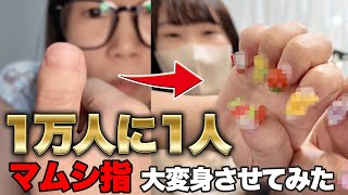 【奇跡】1万人に1人の指を可愛くしてみた💓💅💓