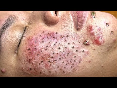 Blackhead Removal With Sac Dep Spa @100074207