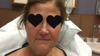 Before and After a Facelift! #facelift #cosmeticsurgery
