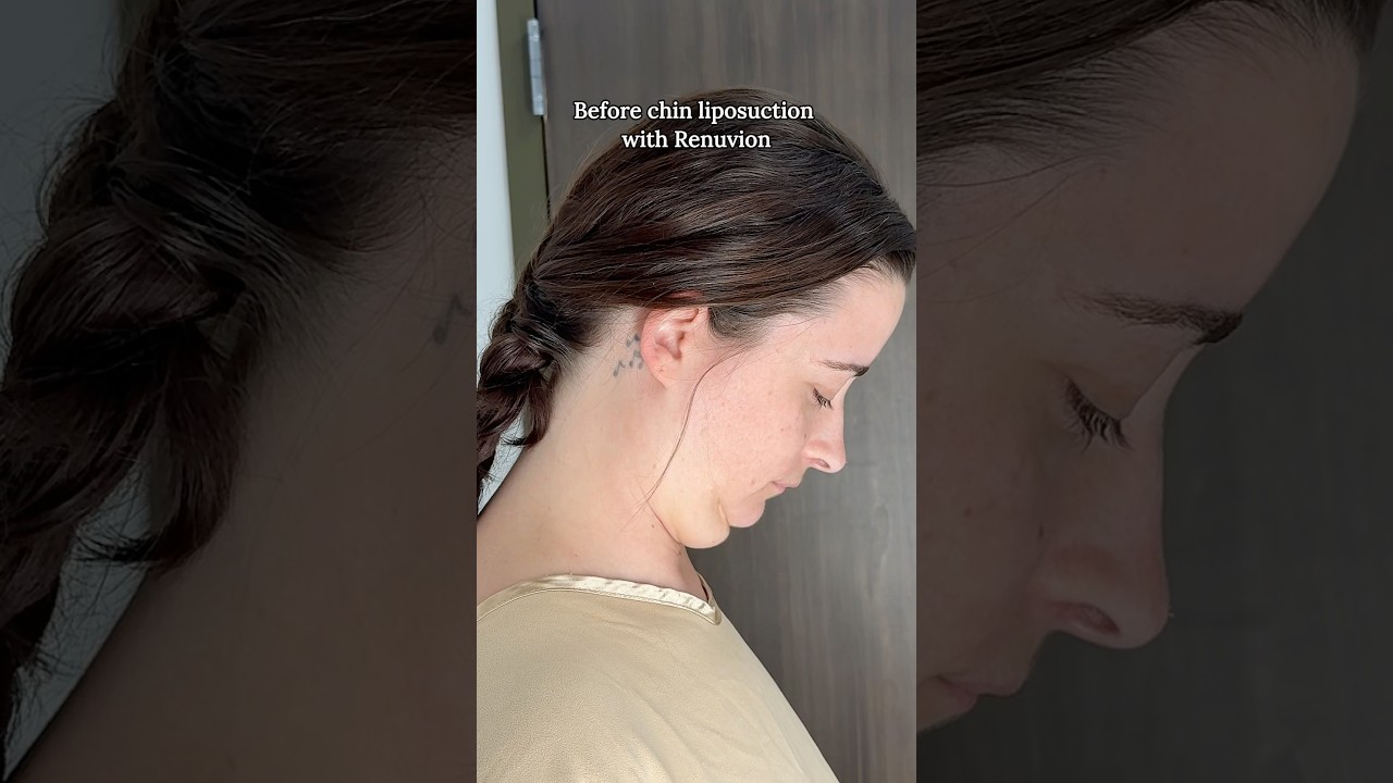 Before chin liposuction consultation with Renuvion.
