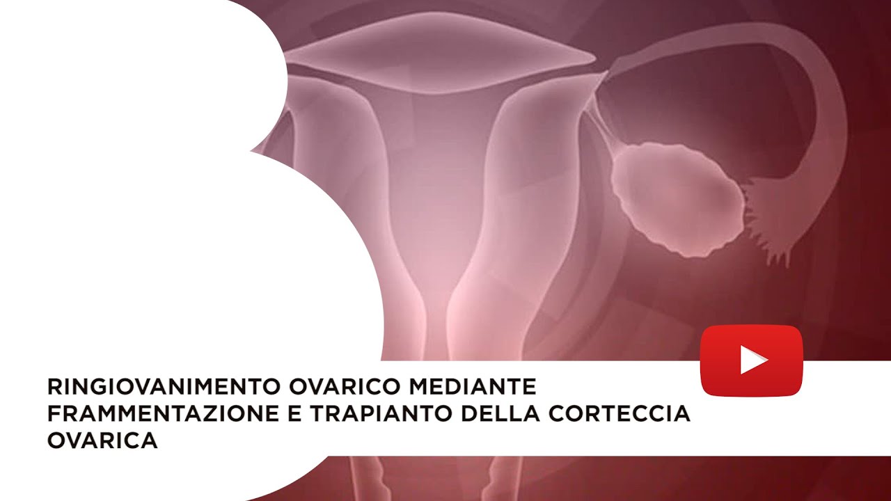 Ringiovanimento ovarico mediante frammentazione e trapianto della corteccia ovarica