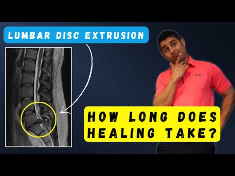 How Long Does It Take for a Disc Extrusion to heal? Find Out