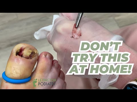 Never Ending Ingrown Removal