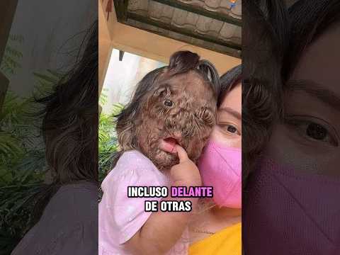 Este beb茅 fue abandonado por sus padres al nacer porque ten铆a pelos por toda la cara 馃挃馃槶 #shortvideo