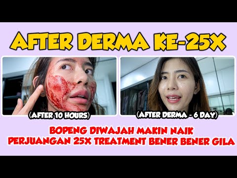 AFTER DERMA 25x - BOPENG MAKIN NAIK, PERJUANGAN 25X TREATMENT BENER BENER GILA🤯