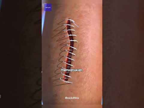 Bagaimana Jahitan Menutup Sebuah Luka?
