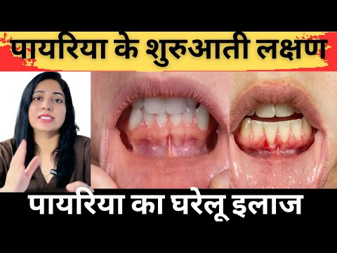 पायरिया के शुरुवाती लक्षण और घरेलु इलाज | Pyorrhea Symptoms And Treatment |