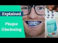 Plaque Disclosing Tablets and Oral Hygiene