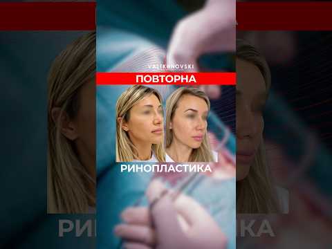 ПОВТОРНА РИНОПЛАСТИКА
