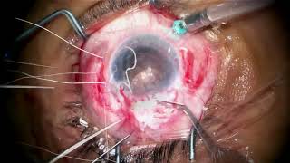 Sutured IOL and silicone iris prosthesis in young woman with previous PK by Steven G. Safran MD