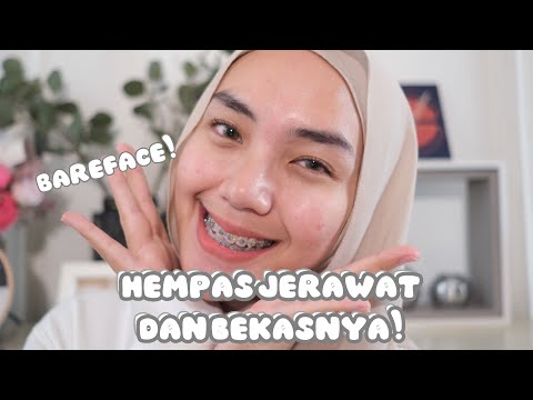 AKU PAKAI SKINCARE INI SEJAK 2009 ‼️ | Skincare Kulit Berjerawat Aman untuk Remaja/ Bumil/ Busui