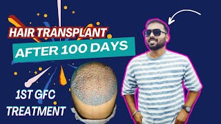 100 दिन बाद बाल का हाल #hairtransplant @ladensitaelucknow