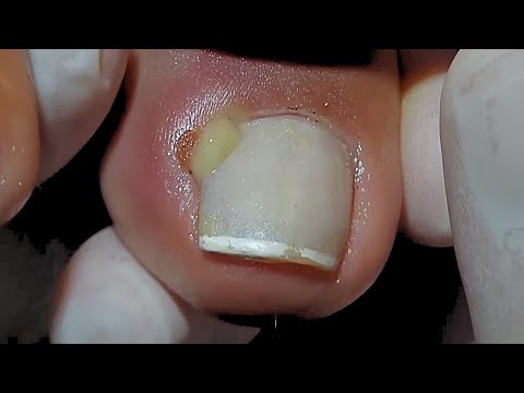 ESSE DEDO CHEGOU AO LIMITE !! #podologomaurelio 