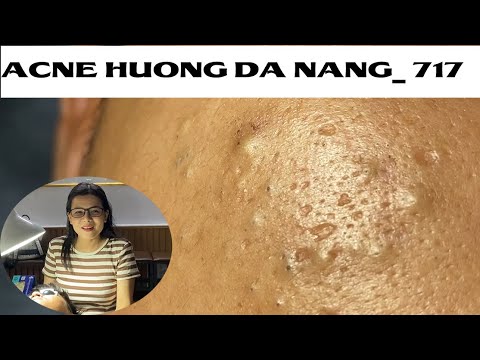 Acne Treatment Huong Da Nang# 717 |   #Remove Blackheads