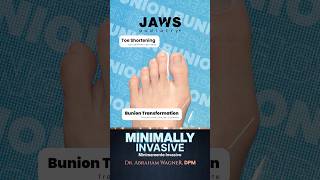 MINIMALLY INVASIVE BUNION & TOE SHORTENING TRANSFORMATION 🙌🏼#shorts #toeshortening #bunionsurgery