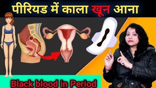 पीरियड में काला खून आना किस बात का संकेत है। black blood in period।