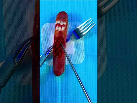 Emergency #FruitSurgery! Glizzy impaled with fork! #DiscountDentist #FoodSurgery #FruitSurgery #ASMR