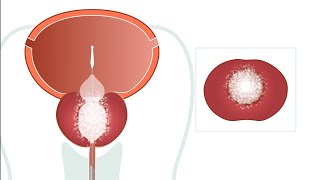 Learn about BPH (Benign Prostatic Hyperplasia) and new breakthrough treatment
