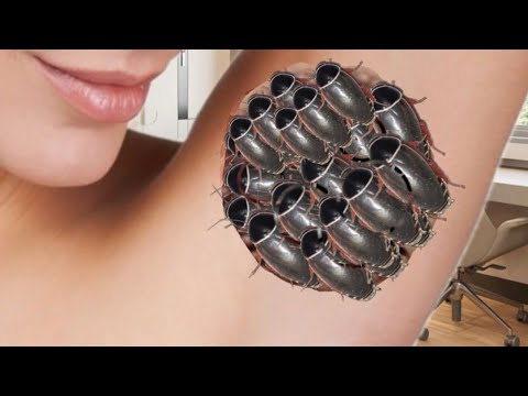 Armpit treatment ASMR | Removing larvae from the ASMR | Watch before bed | Animation for armpit