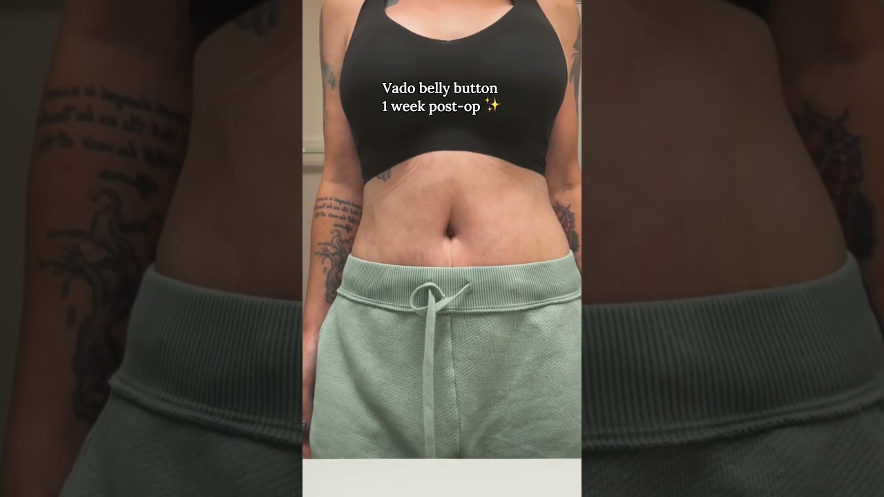 Post-operative belly button after one week.
