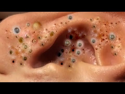 Extreme Blackhead Removal at LNG Skin Care # 65231