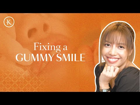 Gummy smile: Fillers & Botox