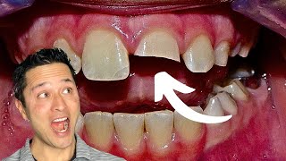 Fractured Incisor Makeover  -  Full Root Canal Retreat & Reconstruction 💪