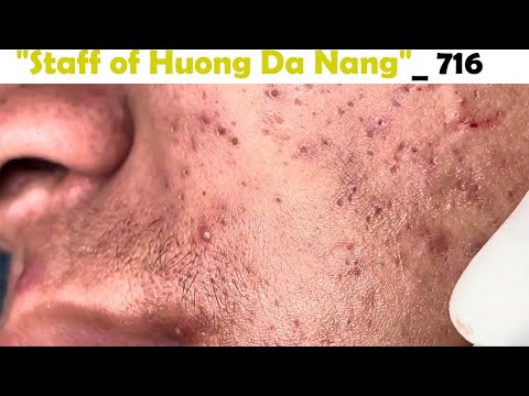 Staff of Huong Da Nang. Very severe acne in a preteen patient. Extracts blackheads#716