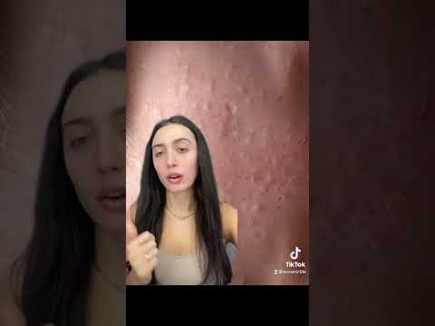 Comedonal acne & fungal acne are commonly mistaken for each other!