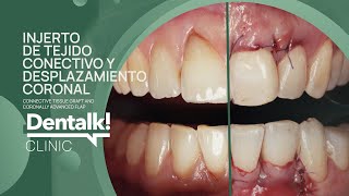 This Is How Dentists Fix Your Gums! Connective soft tissue graft