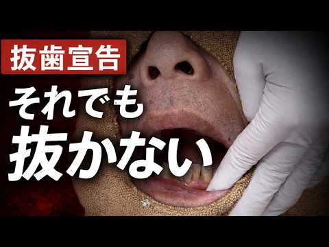 インプラント回避できるのか？重度歯周病のリアルな治療全記録