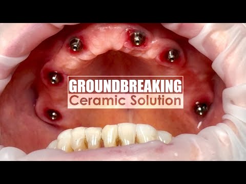 Groundbreaking Ceramic Approach to Full-Mouth Implant Case