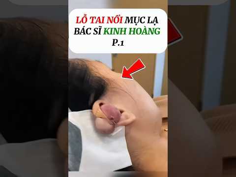 Sốc Toàn Tập! Bác Sĩ Phát Hiện Điều Khủng Khiếp Trong Tai Bệnh Nhân.#vairal #video #shorts #bian