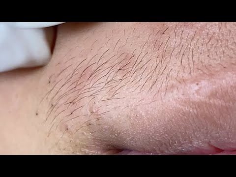 Acne Treatment Huong Da Nang#736 Have a nice day!