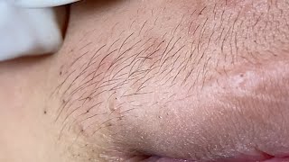 Acne Treatment Huong Da Nang#736 Have a nice day!