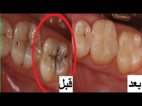 وصفة لازالة تسوس الاسنان والجير فى يوم واحد