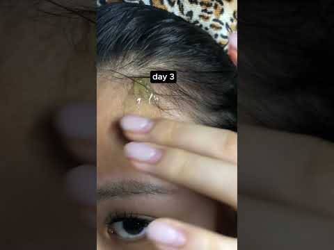 GIANT PIMPLE TREATMENT😭 #celimax