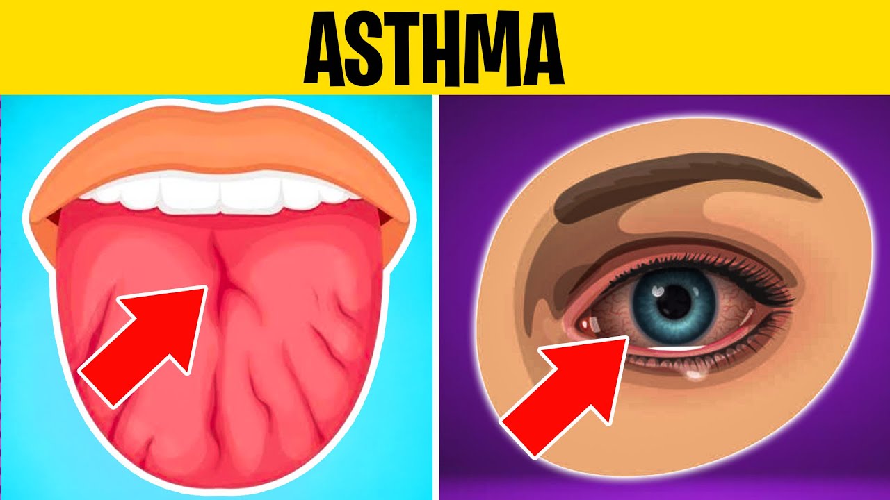 7 EARLY Signs & Symptoms of ASTHMA People Always Ignore