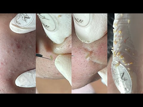 Get rid of pimples easily with Ngoc - Acnes Treatments Mai Ngoc 💕💕💕