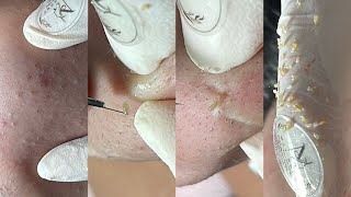 Get rid of pimples easily with Ngoc - Acnes Treatments Mai Ngoc 💕💕💕