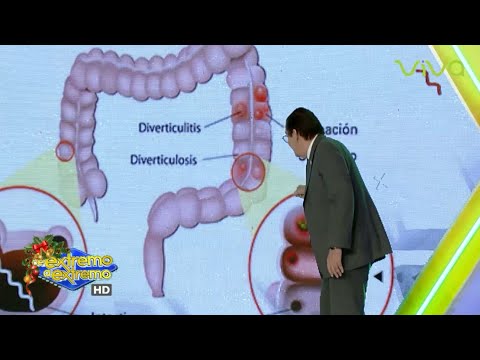 Diverticulitis en el colon - Salud Extrema