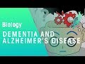 Understanding Dementia and Alzheimer's Disease