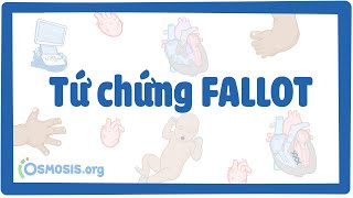 Tứ chứng fallot