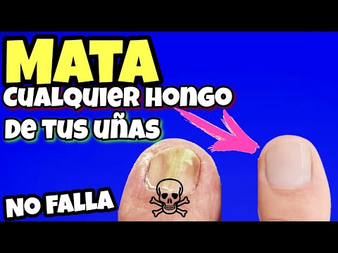 ESTO es CIEN veces más Efectivo Que otros Remedios CASEROS para MATAR los Hongos en las Uñas